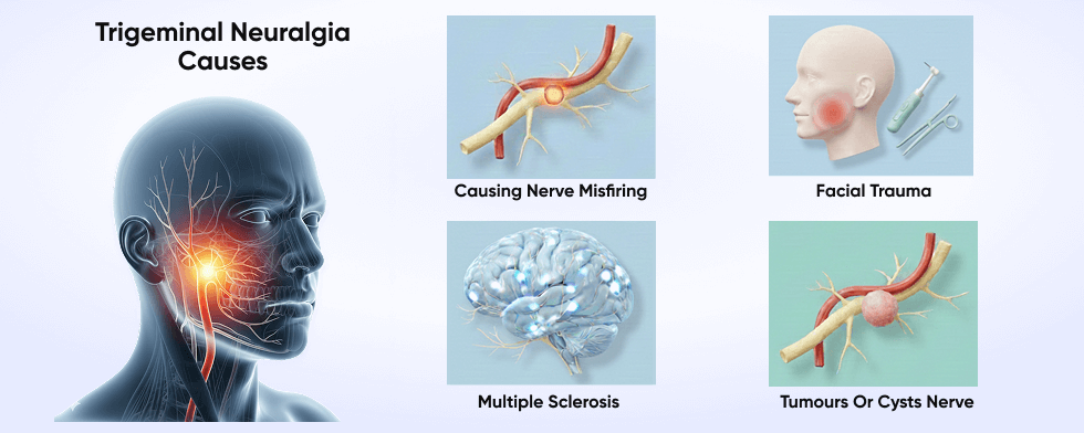 Trigeminal Neuralgia Causes