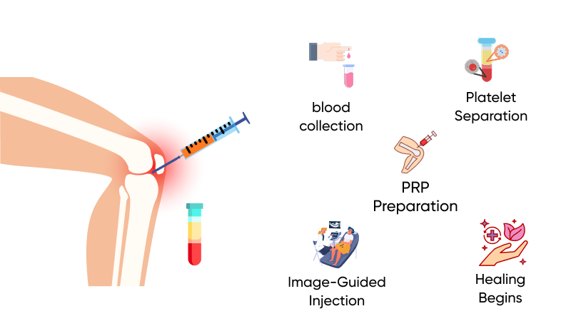 How Does PRP Therapy Work?