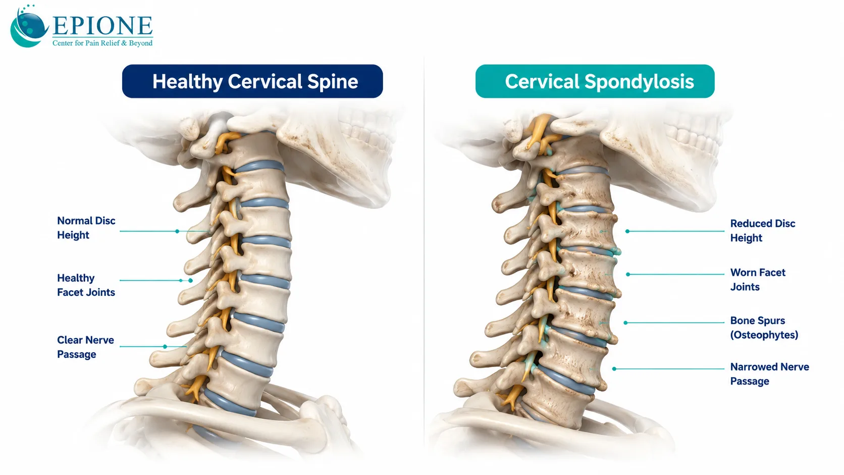 Illustration comparing a healthy cervical spine with cervical spondylosis